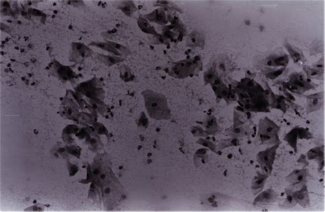 Bacterial vaginosis: comparison of Pap smear and microbiological .
